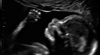 19weekultrasound